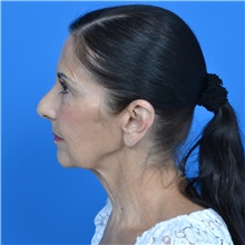 Facelift Before Photo by Jonathan Weinrach, MD; ,  - Case 36884
