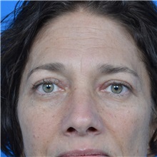 Eyelid Surgery After Photo by Jonathan Weinrach, MD; Scottsdale, AZ - Case 36893