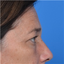 Eyelid Surgery Before Photo by Jonathan Weinrach, MD; Scottsdale, AZ - Case 36893
