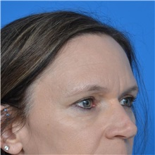 Eyelid Surgery After Photo by Jonathan Weinrach, MD; Scottsdale, AZ - Case 36895