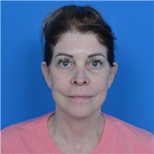 Facelift After Photo by Jonathan Weinrach, MD; Scottsdale, AZ - Case 37466