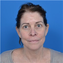 Facelift Before Photo by Jonathan Weinrach, MD; Scottsdale, AZ - Case 37466