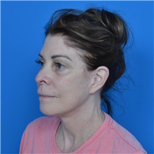 Facelift After Photo by Jonathan Weinrach, MD; Scottsdale, AZ - Case 37466