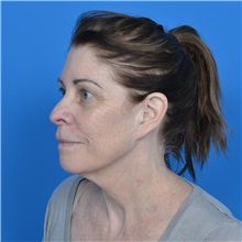Facelift Before Photo by Jonathan Weinrach, MD; Scottsdale, AZ - Case 37466