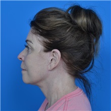 Facelift After Photo by Jonathan Weinrach, MD; Scottsdale, AZ - Case 37466