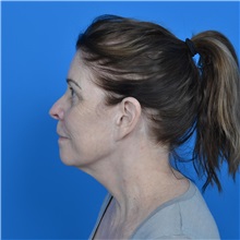 Facelift Before Photo by Jonathan Weinrach, MD; Scottsdale, AZ - Case 37466