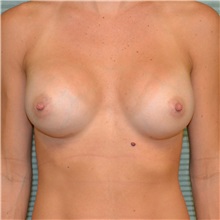 Breast Augmentation After Photo by Jonathan Weinrach, MD; Scottsdale, AZ - Case 37630