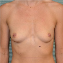 Breast Augmentation Before Photo by Jonathan Weinrach, MD; Scottsdale, AZ - Case 37630