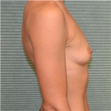 Breast Augmentation Before Photo by Jonathan Weinrach, MD; ,  - Case 37630