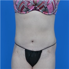 Tummy Tuck After Photo by Jonathan Weinrach, MD; Scottsdale, AZ - Case 37631