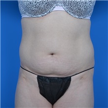 Tummy Tuck Before Photo by Jonathan Weinrach, MD; Scottsdale, AZ - Case 37631