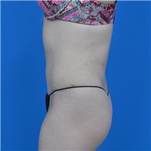 Tummy Tuck After Photo by Jonathan Weinrach, MD; ,  - Case 37631