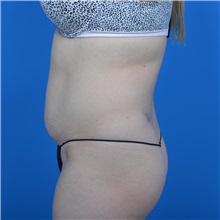 Tummy Tuck Before Photo by Jonathan Weinrach, MD; ,  - Case 37631