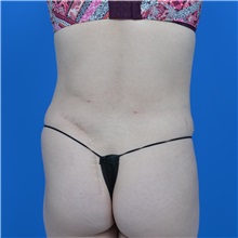 Tummy Tuck After Photo by Jonathan Weinrach, MD; ,  - Case 37631