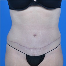 Tummy Tuck After Photo by Jonathan Weinrach, MD; Scottsdale, AZ - Case 37632