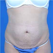 Tummy Tuck Before Photo by Jonathan Weinrach, MD; Scottsdale, AZ - Case 37632