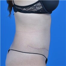 Tummy Tuck After Photo by Jonathan Weinrach, MD; ,  - Case 37632