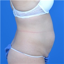 Tummy Tuck Before Photo by Jonathan Weinrach, MD; ,  - Case 37632
