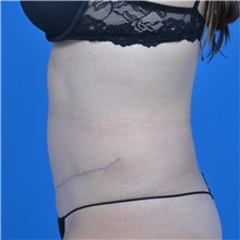 Tummy Tuck After Photo by Jonathan Weinrach, MD; ,  - Case 37632