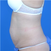 Tummy Tuck Before Photo by Jonathan Weinrach, MD; ,  - Case 37632