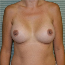 Breast Augmentation After Photo by Jonathan Weinrach, MD; ,  - Case 37685