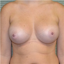 Breast Augmentation After Photo by Jonathan Weinrach, MD; Scottsdale, AZ - Case 37686