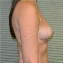 Breast Augmentation Before Photo by Jonathan Weinrach, MD; ,  - Case 37686