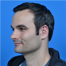 Ear Surgery After Photo by Jonathan Weinrach, MD; ,  - Case 38847