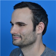 Ear Surgery Before Photo by Jonathan Weinrach, MD; ,  - Case 38847