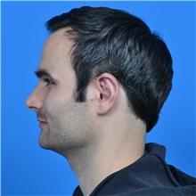 Ear Surgery After Photo by Jonathan Weinrach, MD; ,  - Case 38847