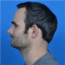 Ear Surgery Before Photo by Jonathan Weinrach, MD; ,  - Case 38847