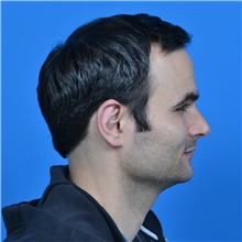 Ear Surgery After Photo by Jonathan Weinrach, MD; ,  - Case 38847