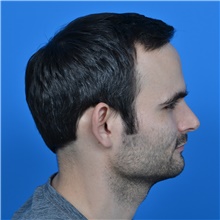 Ear Surgery Before Photo by Jonathan Weinrach, MD; ,  - Case 38847