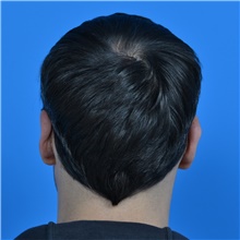 Ear Surgery After Photo by Jonathan Weinrach, MD; ,  - Case 38847