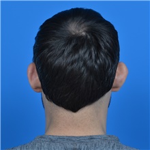 Ear Surgery Before Photo by Jonathan Weinrach, MD; ,  - Case 38847