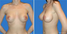 Breast Augmentation After Photo by William Franckle, MD; Voorhees, NJ - Case 27283