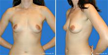 Breast Augmentation Before Photo by William Franckle, MD; Voorhees, NJ - Case 27283