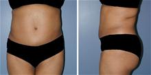 Tummy Tuck After Photo by William Franckle, MD; Voorhees, NJ - Case 27392