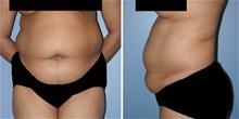 Tummy Tuck Before Photo by William Franckle, MD; Voorhees, NJ - Case 27392