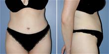 Tummy Tuck After Photo by William Franckle, MD; Voorhees, NJ - Case 27394