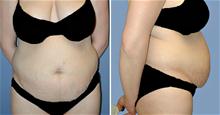 Tummy Tuck Before Photo by William Franckle, MD; Voorhees, NJ - Case 27394