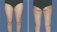 Liposuction After Photo by William Franckle, MD; Voorhees, NJ - Case 27644