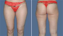 Liposuction Before Photo by William Franckle, MD; Voorhees, NJ - Case 27644