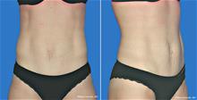 Tummy Tuck After Photo by William Franckle, MD; Voorhees, NJ - Case 27842