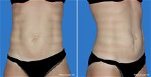 Tummy Tuck Before Photo by William Franckle, MD; Voorhees, NJ - Case 27842