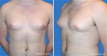 Male Breast Reduction After Photo by William Franckle, MD; Voorhees, NJ - Case 28888