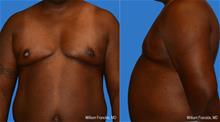 Male Breast Reduction After Photo by William Franckle, MD; Voorhees, NJ - Case 28889