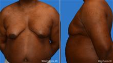 Male Breast Reduction Before Photo by William Franckle, MD; Voorhees, NJ - Case 28889