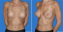 Breast Augmentation After Photo by William Franckle, MD; Voorhees, NJ - Case 28984