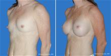 Breast Augmentation After Photo by William Franckle, MD; Voorhees, NJ - Case 29015